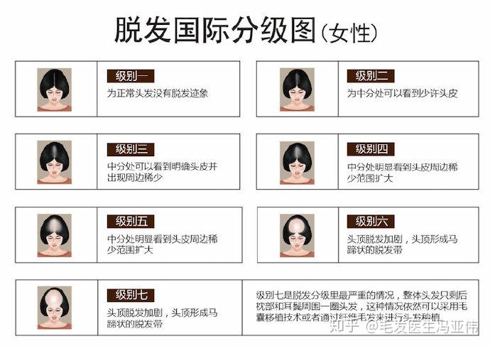 还有很多人对于自己的脱发等级不了解,下面两张图大家可以具体来看一