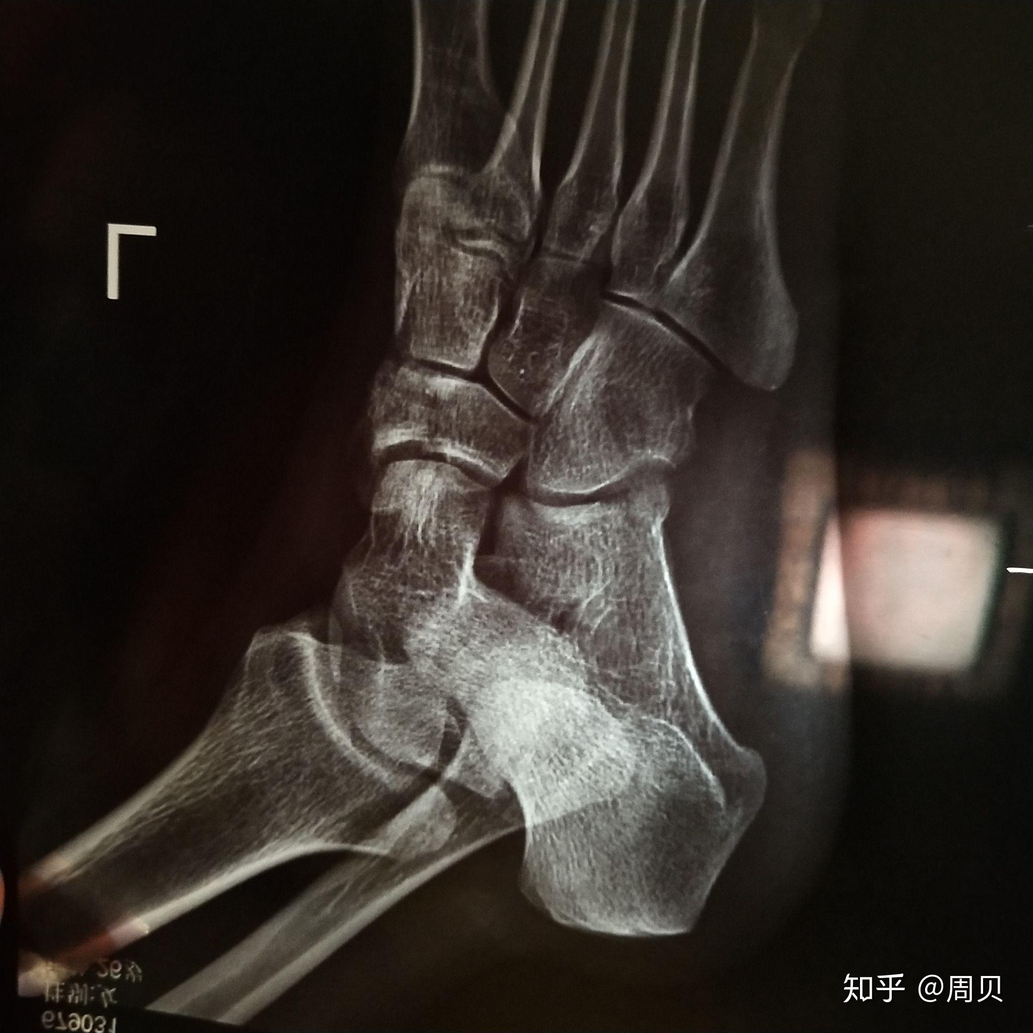 『8分钟创伤』舟状骨骨折固定方案详解，看完的人都收藏了！ - 上海开为医药科技有限公司--创伤、肢体矫形技术解决方案的专业服务商