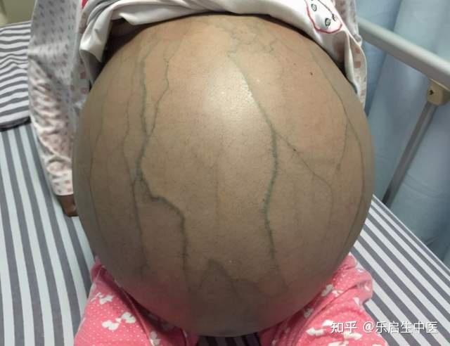 胃癌伴发腹水反复抽腹水太痛苦如何才能从根源上减少腹水