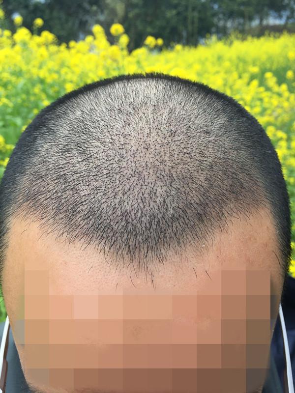 为什么秃顶的人这么多很少有做植发的?