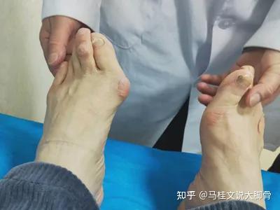 拇外翻并发拇囊炎是什么情况？ - 知乎