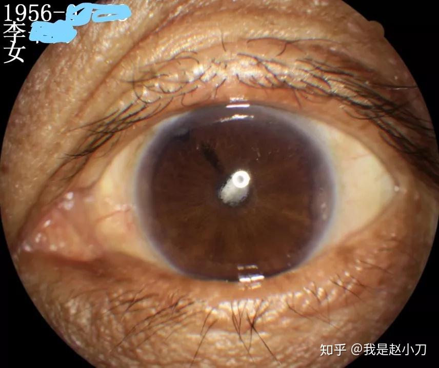 葡萄膜炎一拖再拖不得不拖的白内障手术赵小刀手术日志