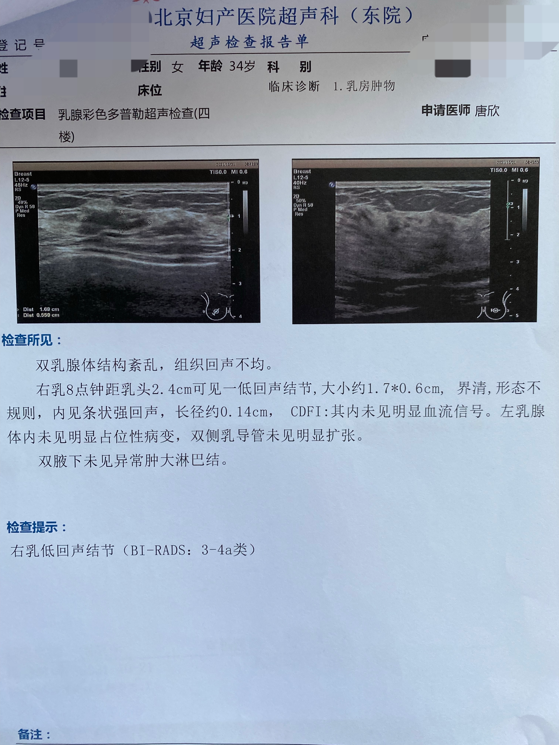 34歲女性,超聲提示右乳結節,鉬靶提示右乳中下象限多發分支鈣化