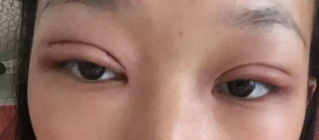 埋线双眼皮能保持多久?