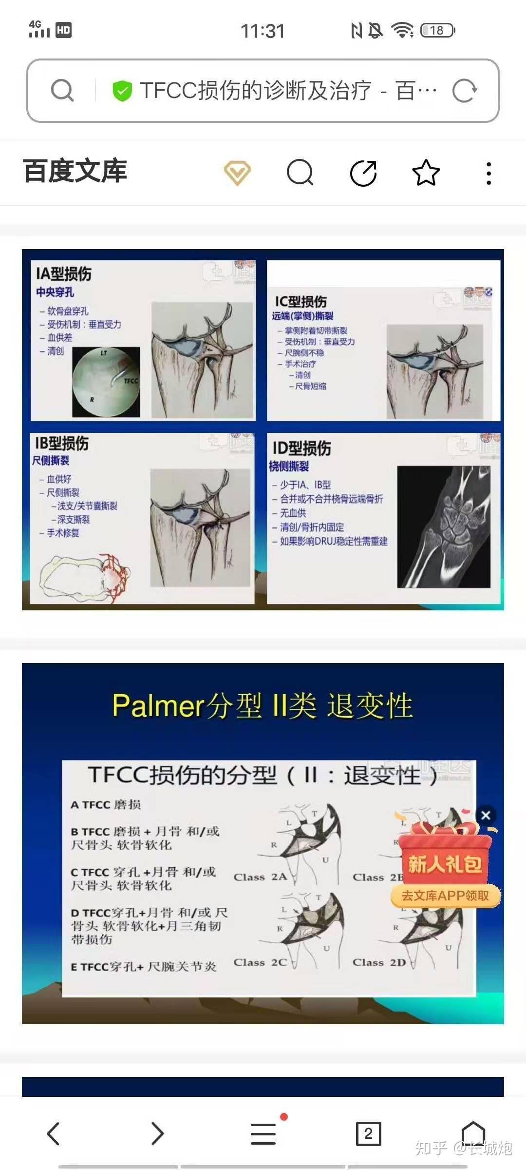 tfcc手腕三角軟骨複合體科普