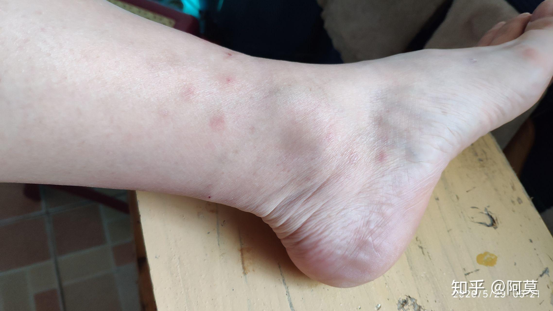 亲测被跳蚤咬了止痒消肿的绝对有效的办法