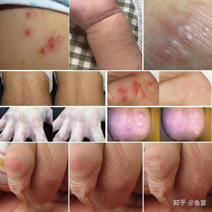 初起皮疹多见于皮肤潮湿柔软处,如手指间,手腕部位的皮肤容易穿主寄生
