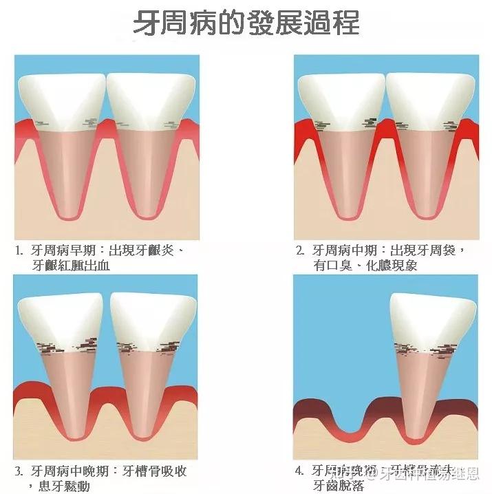 导致牙齿支持组织的破坏——牙周袋形成