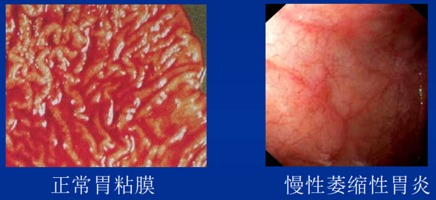 消化病理学：胃炎 知乎 