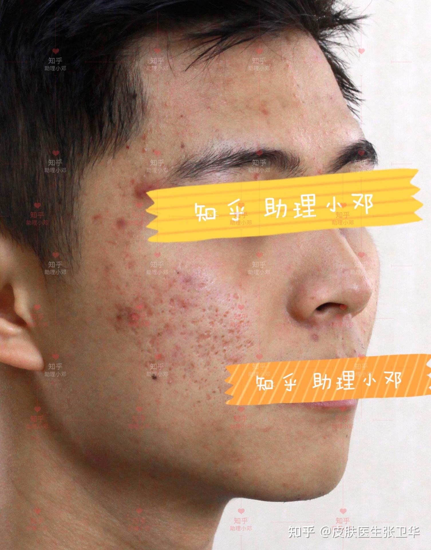 厢车型的痘坑问题做了两组综合激光后的对比反馈来了