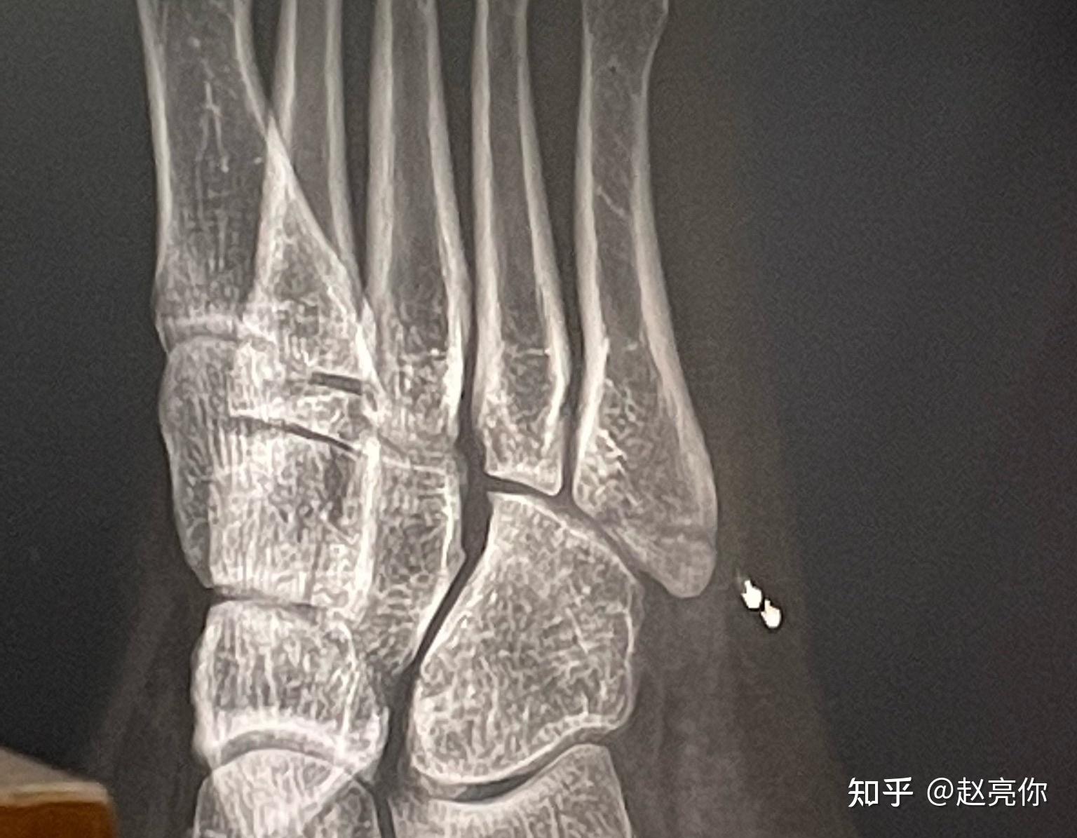 左脚第5趾骨骨折 之 治疗+生活日常记录（2021.11.2～康复进行时） - 知乎