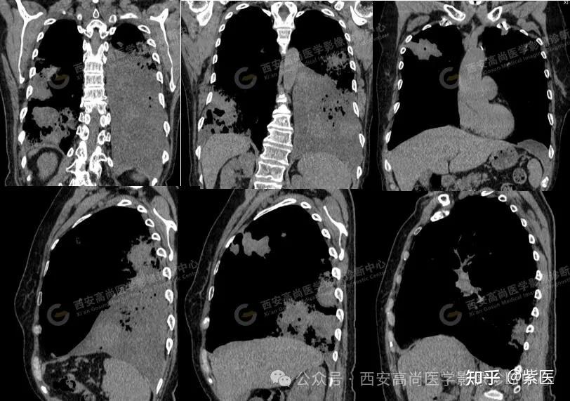 咳嗽痰中带血、胸闷气短明显,CT诊断肺粘液腺癌 - 知乎