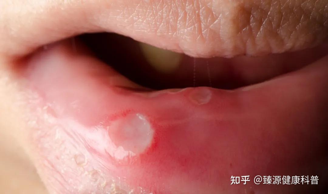 红——周围一圈红色充血带;黄——表面有黄色假膜;口腔溃疡有非常显著