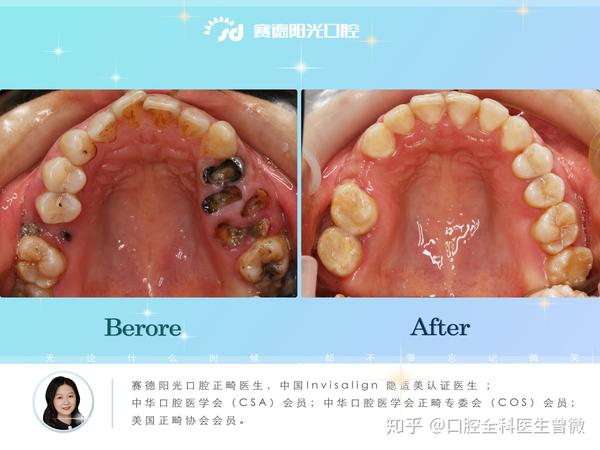 齲齒蛀牙能嚴重到什麼地步