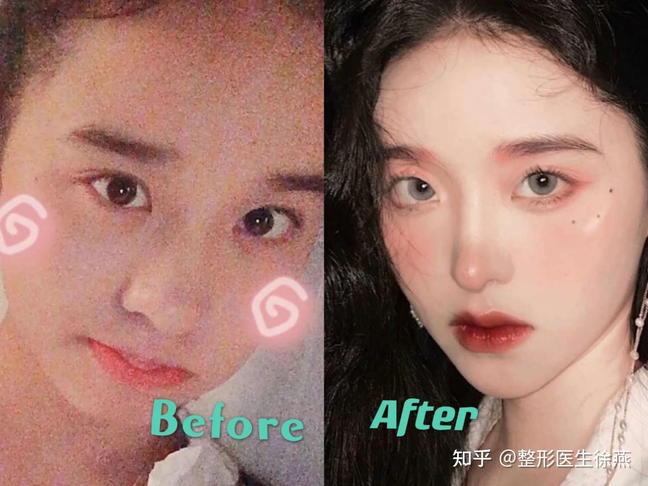 靠颜值在抖音圈了三百万粉丝的steph,缩鼻翼,垫高鼻梁,精塑鼻尖,颜值