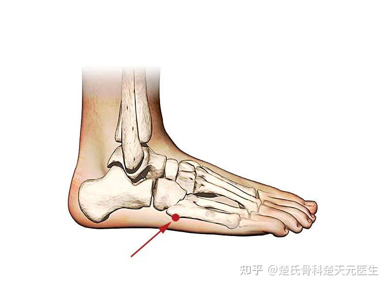 02外踝01內踝崴腳後用手按壓以下這些部位:如何初步判斷是否骨折?