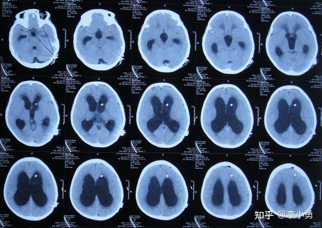 脑膜炎性脑积水4家医院8次住院3次手术(三室造瘘,脑室腹腔分流和脑室