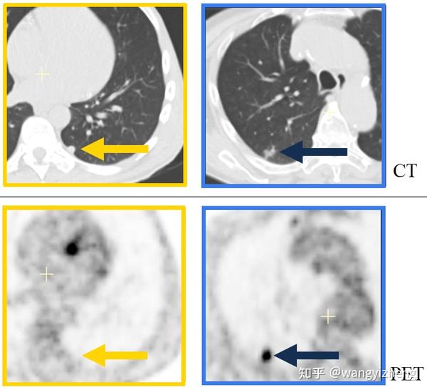 正电子发射断层扫描PET是如何诊断癌症的？ - 知乎