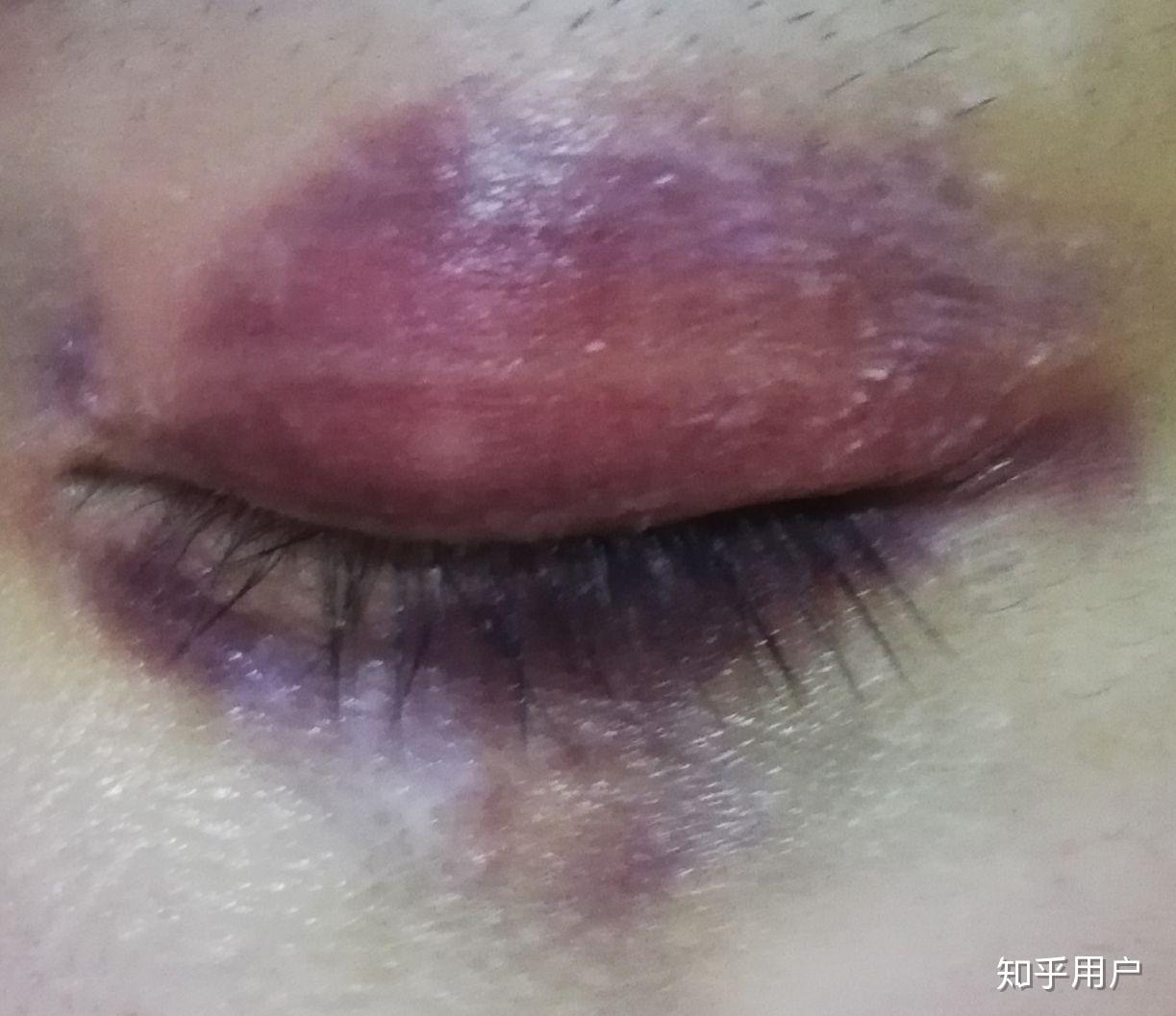 想知道眼部淤青怎么可以快速消除