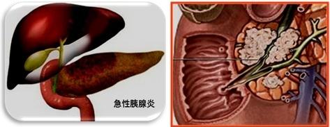 第二十五章 胰腺疾病病人的护理 - 知乎