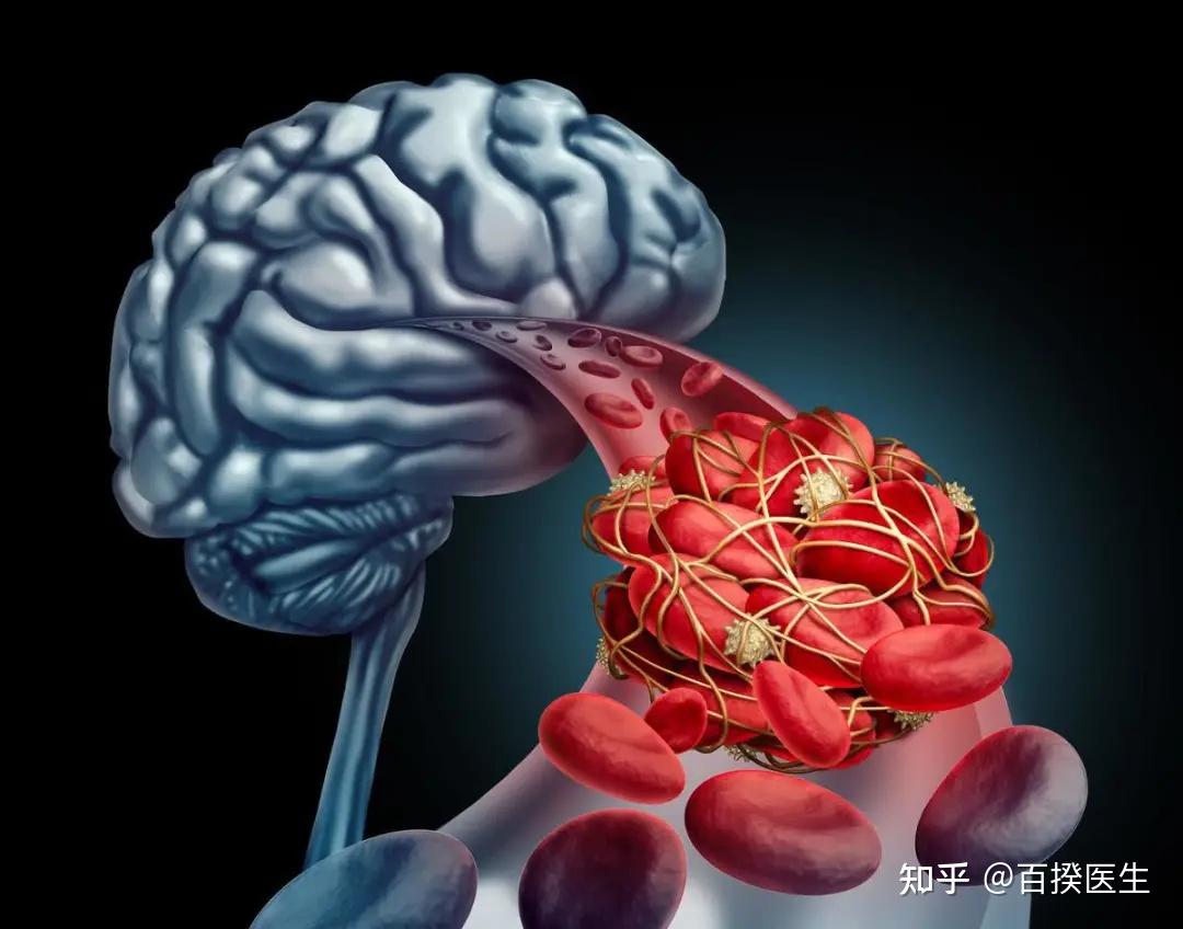 脑供血不足的人，头部若出现4种表现，多半是脑梗，劝你早查脑CT|脑供血不足|脑CT|头部_新浪新闻