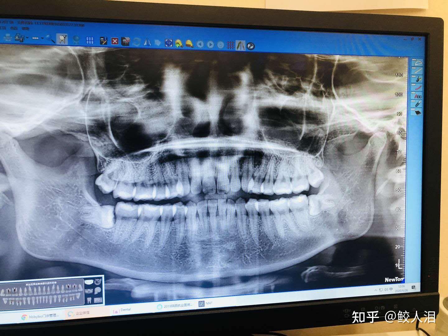 在北京北大口腔医院魏公村总院拔牙的经历
