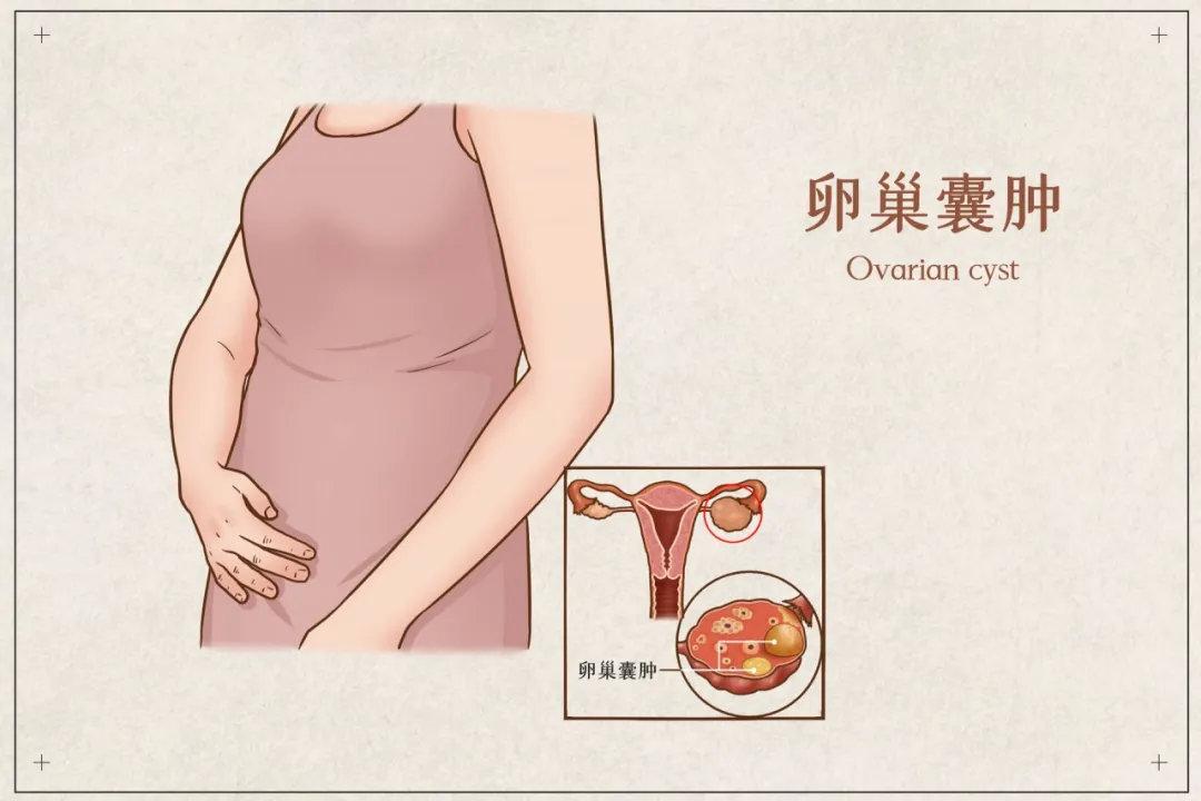 卵巢囊肿会不会影响怀孕?