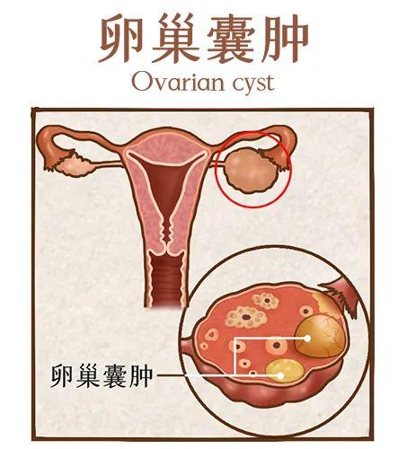 大多數情況下都是排卵後形成的生理性囊腫,比如濾泡囊腫,黃體囊腫