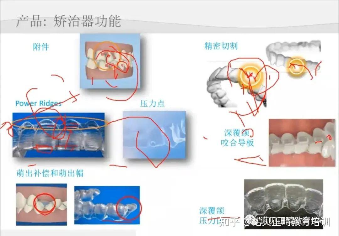 前前牙前磨牙及17反合7檢查齦方斜面楔形附件在垂直方向有沒有倒凹