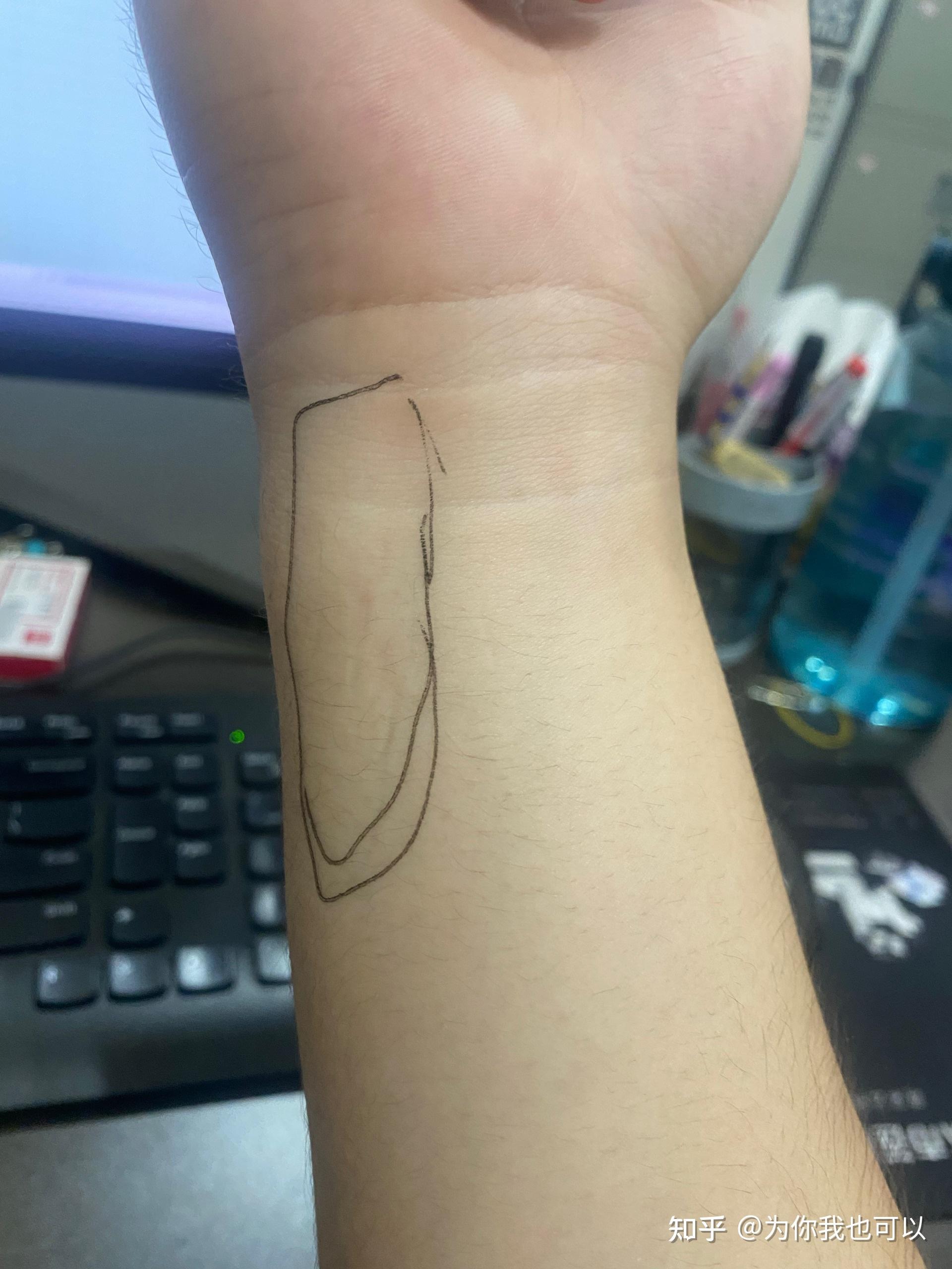 手腕TFCC损失两年 - 知乎