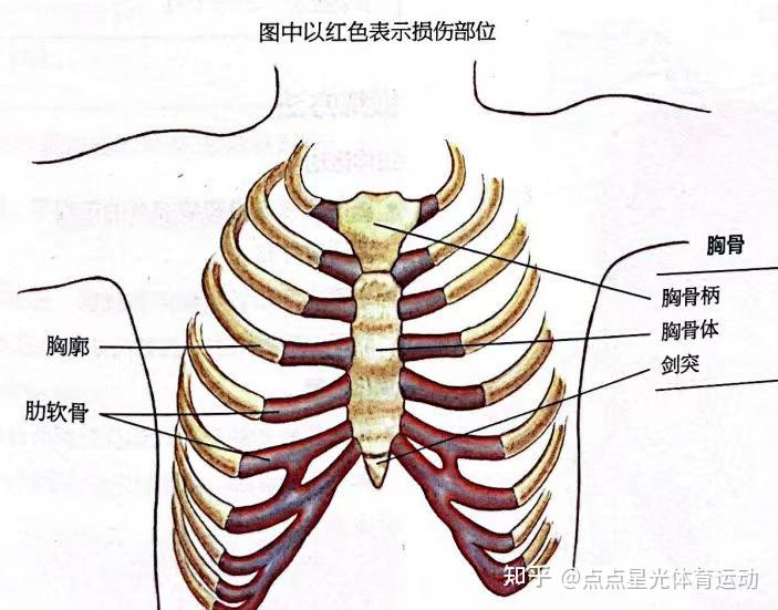 肋软骨炎示意图图片