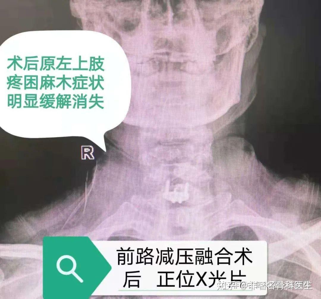 【高危挑战】西青医院骨二科首例为一上颈椎骨折患者完成颈椎后路植骨融合椎弓根钉内固定术_手术