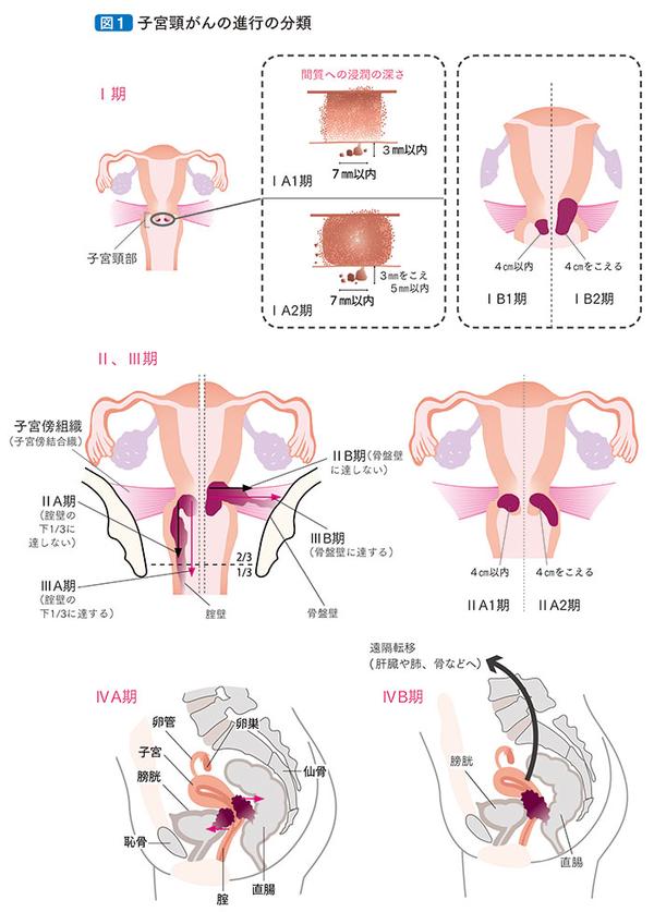 宫颈癌的防治 知乎