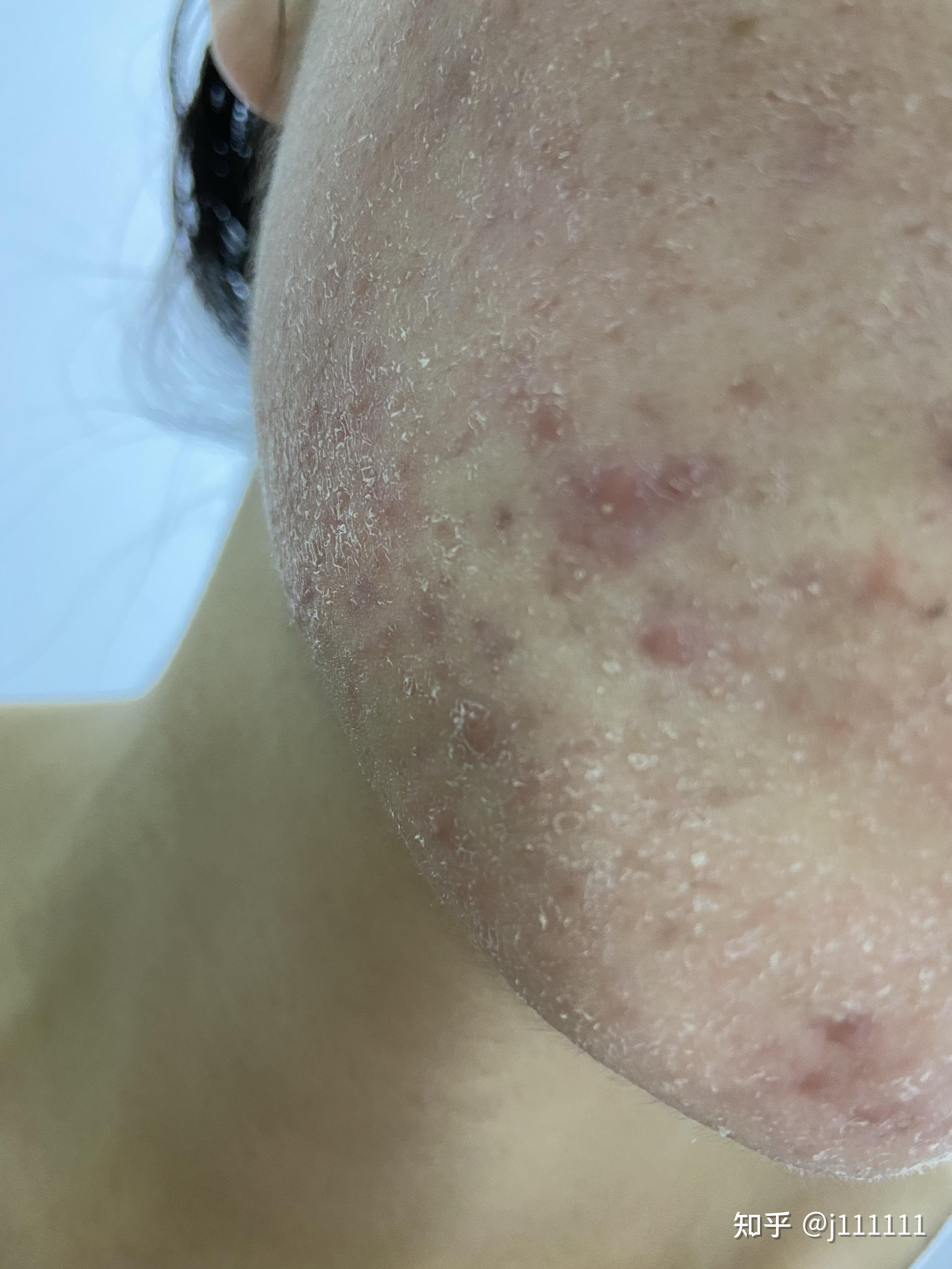 油痘肌冬天爆皮怎么办求助各位大神