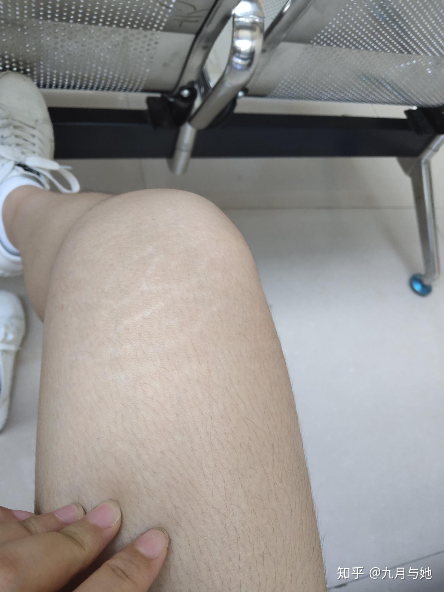 大腿皮肤出现网状花纹图片
