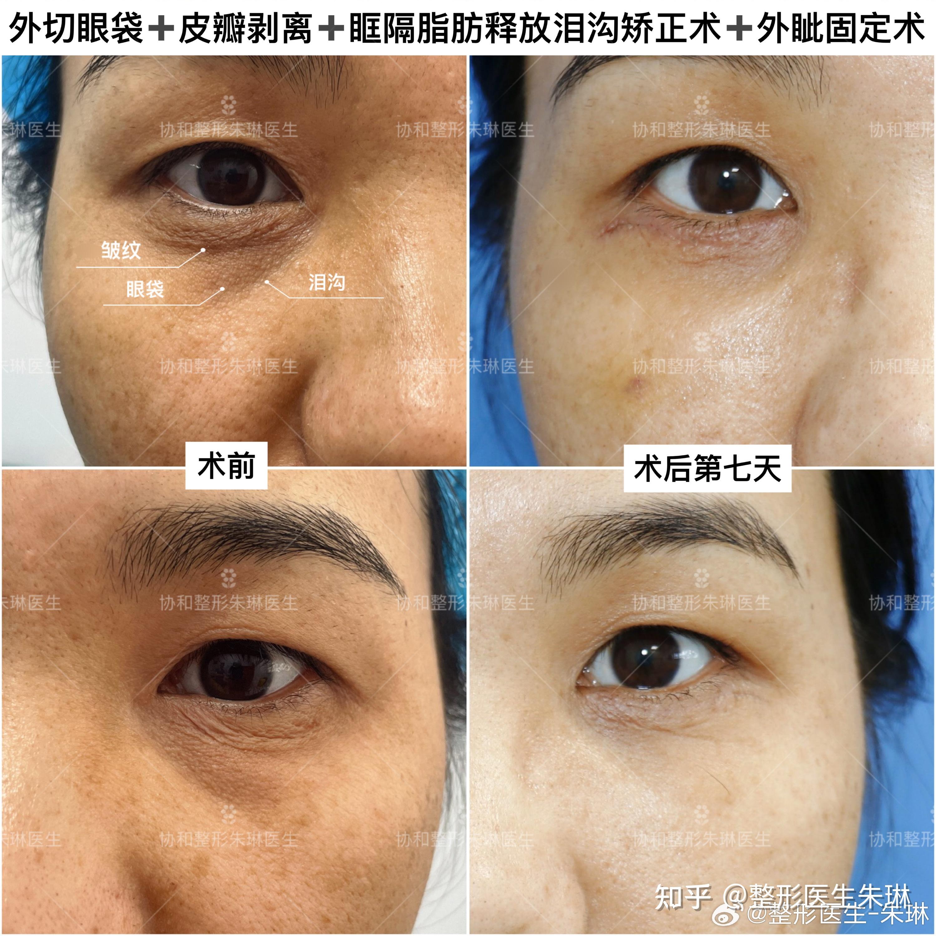 北京外切眼袋77皮瓣剥离77眶隔脂肪释放泪沟矫正术77外眦固定术