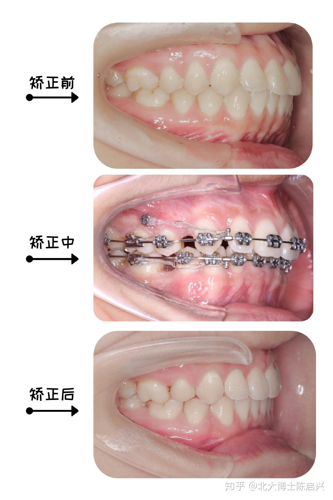 同样用于牙齿正畸，骨钉和附件有什么区别？_斯迈尔齿科(SME)官方网站 - 一次选择 终身相伴