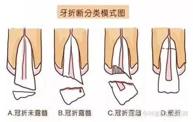 牙齿磕掉了一小块,不痛不痒的,要治疗吗? - 知乎