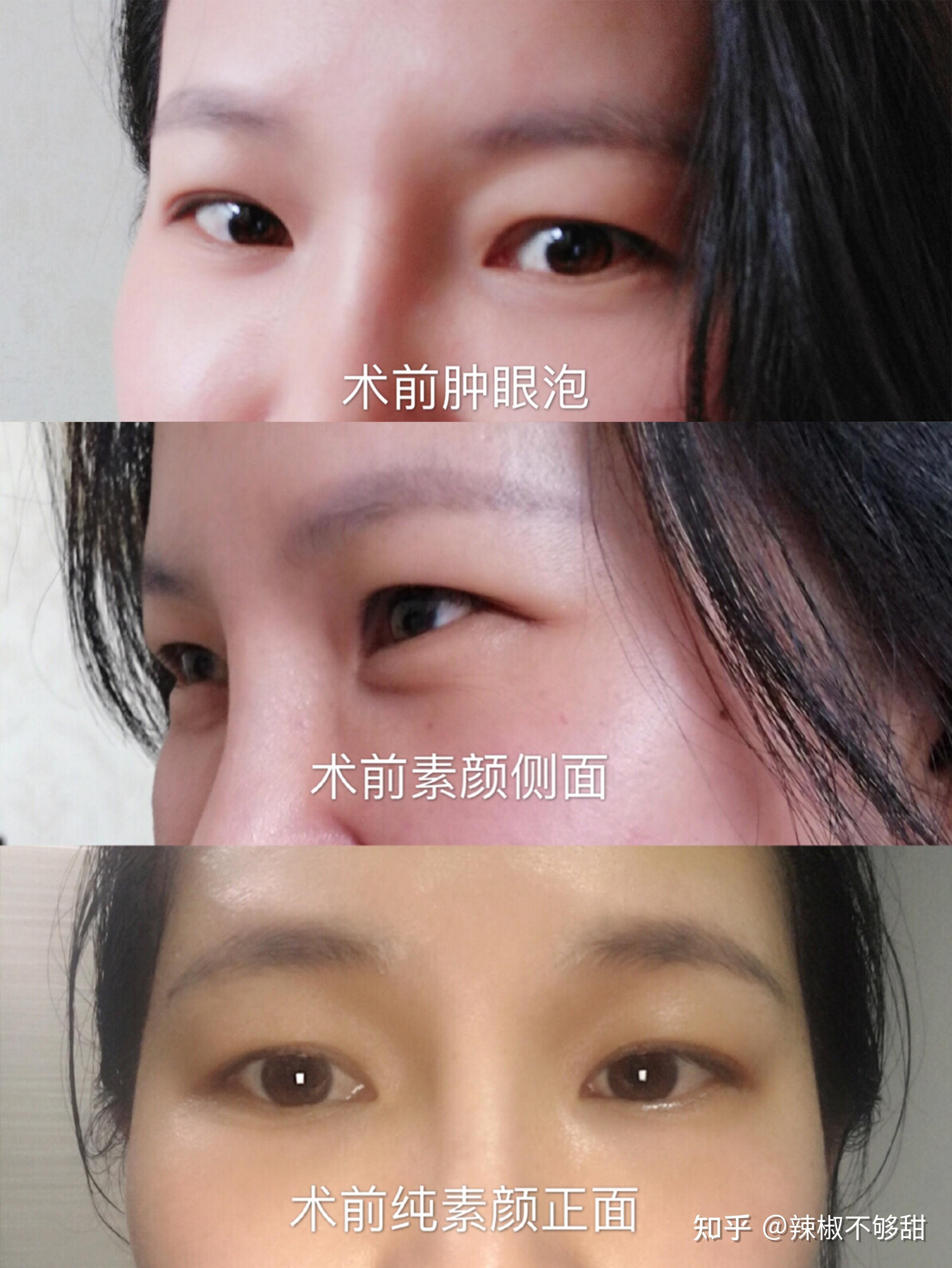 筋膜悬吊提眉手术一个月后的效果，准备做提眉手术的姐妹们来看看术后情况 - 知乎