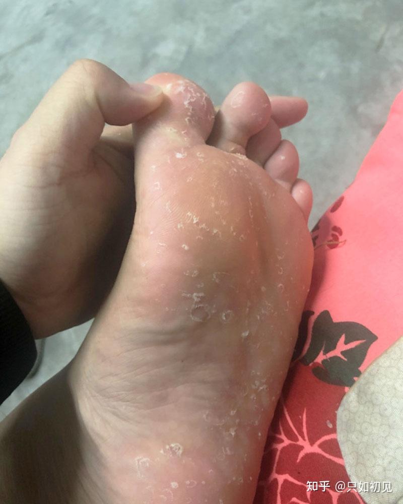 你的脚气怎么治的亲测有效的方法分享