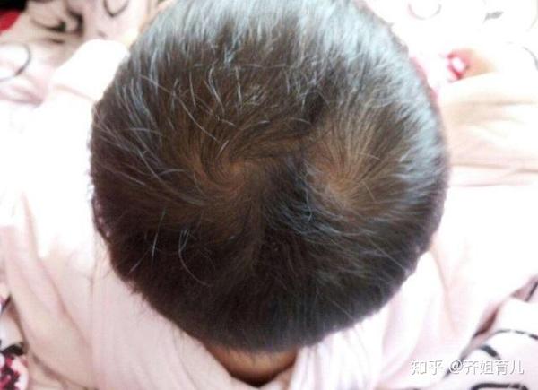“一旋好,二旋坏?”孩子头顶有两个旋,背后到底有什么含义 - 知乎