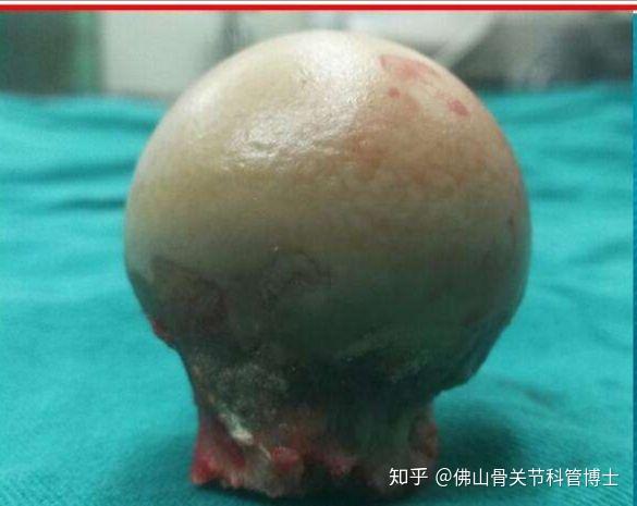 正常股骨头与缺血性坏死股骨头的主要区别是什么