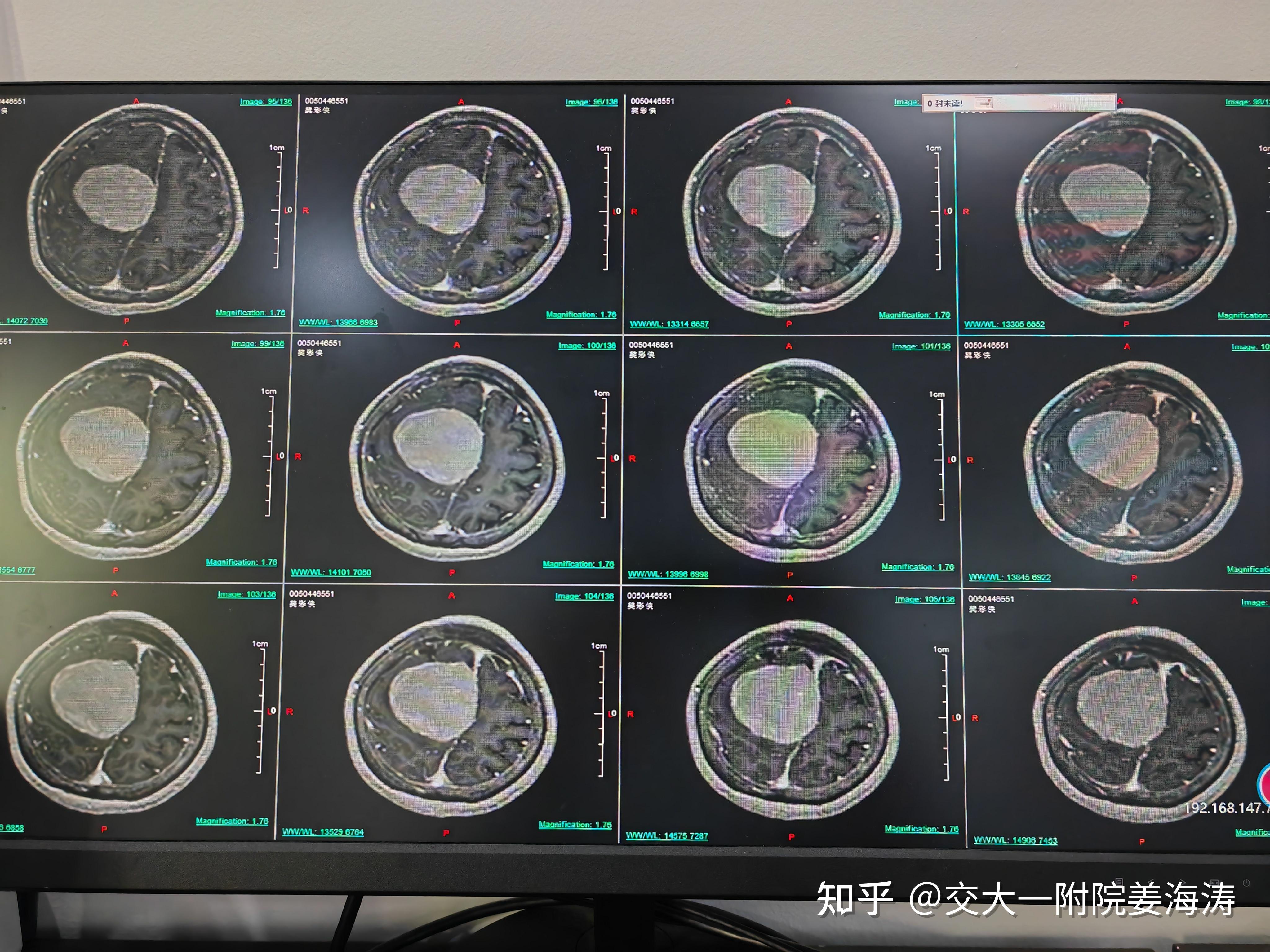 大脑镰旁脑膜瘤图片