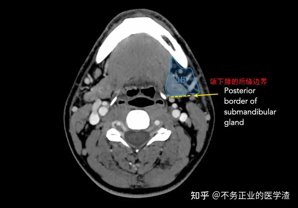 颌下腺位置图片CT图片