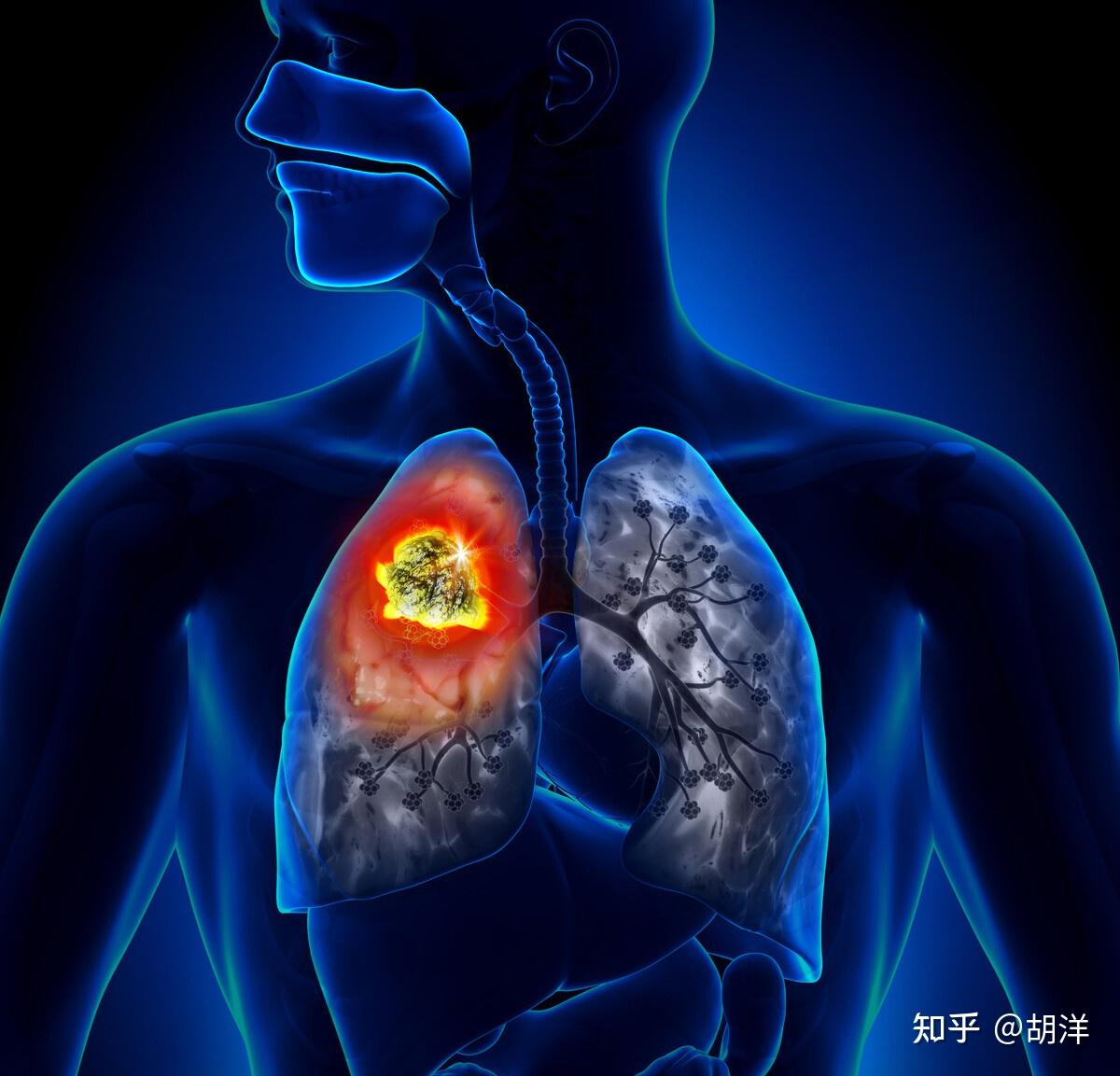 左肺腺癌并多发转移一例 - 病例中心(诊疗助手) - 爱爱医医学网