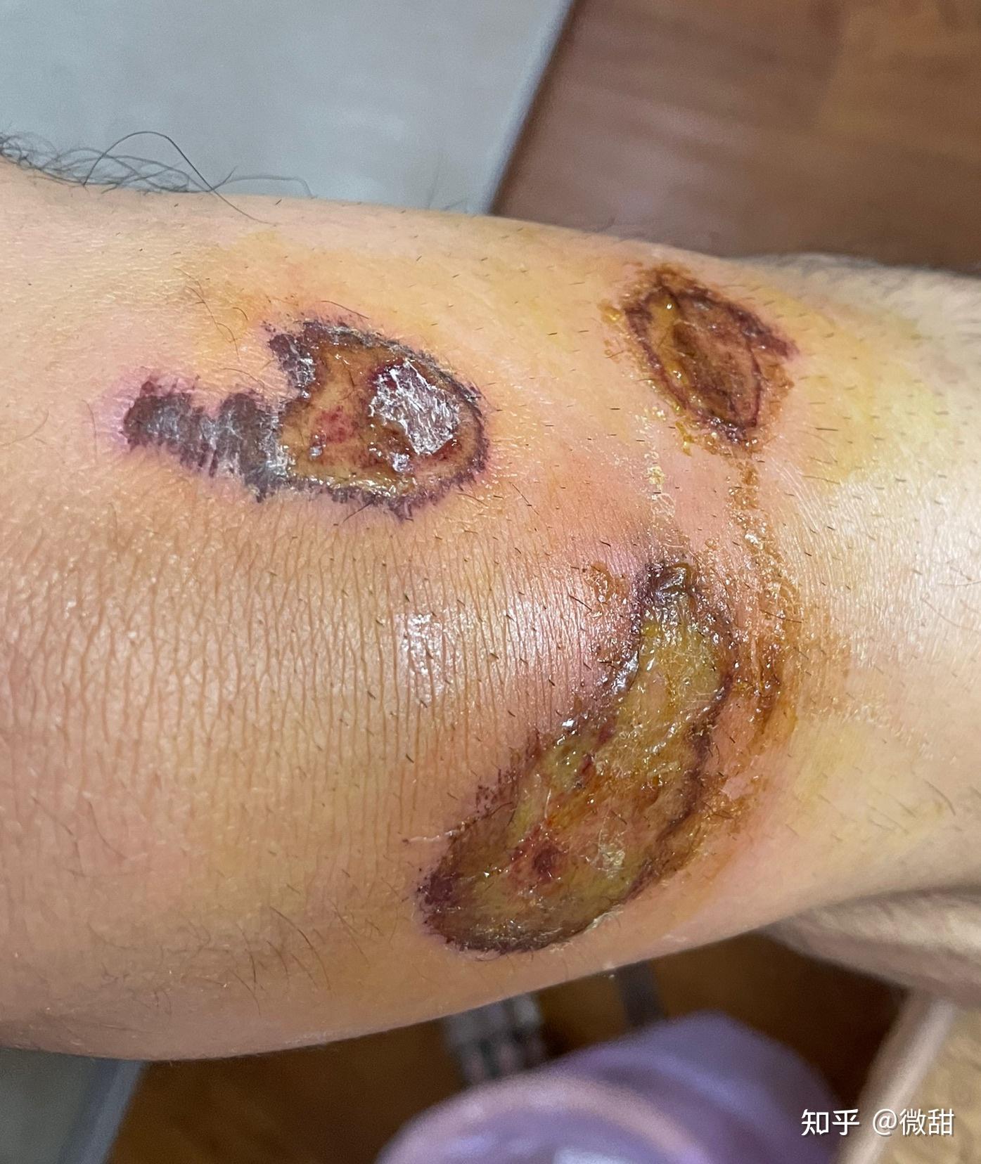 膝盖摔伤痛苦的回忆大佬们该怎么上药啊