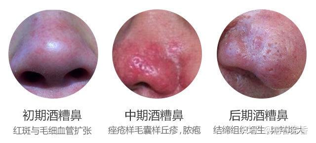 酒糟鼻.我的工头是,那梦香草园,记得我的,德国洋甘菊.