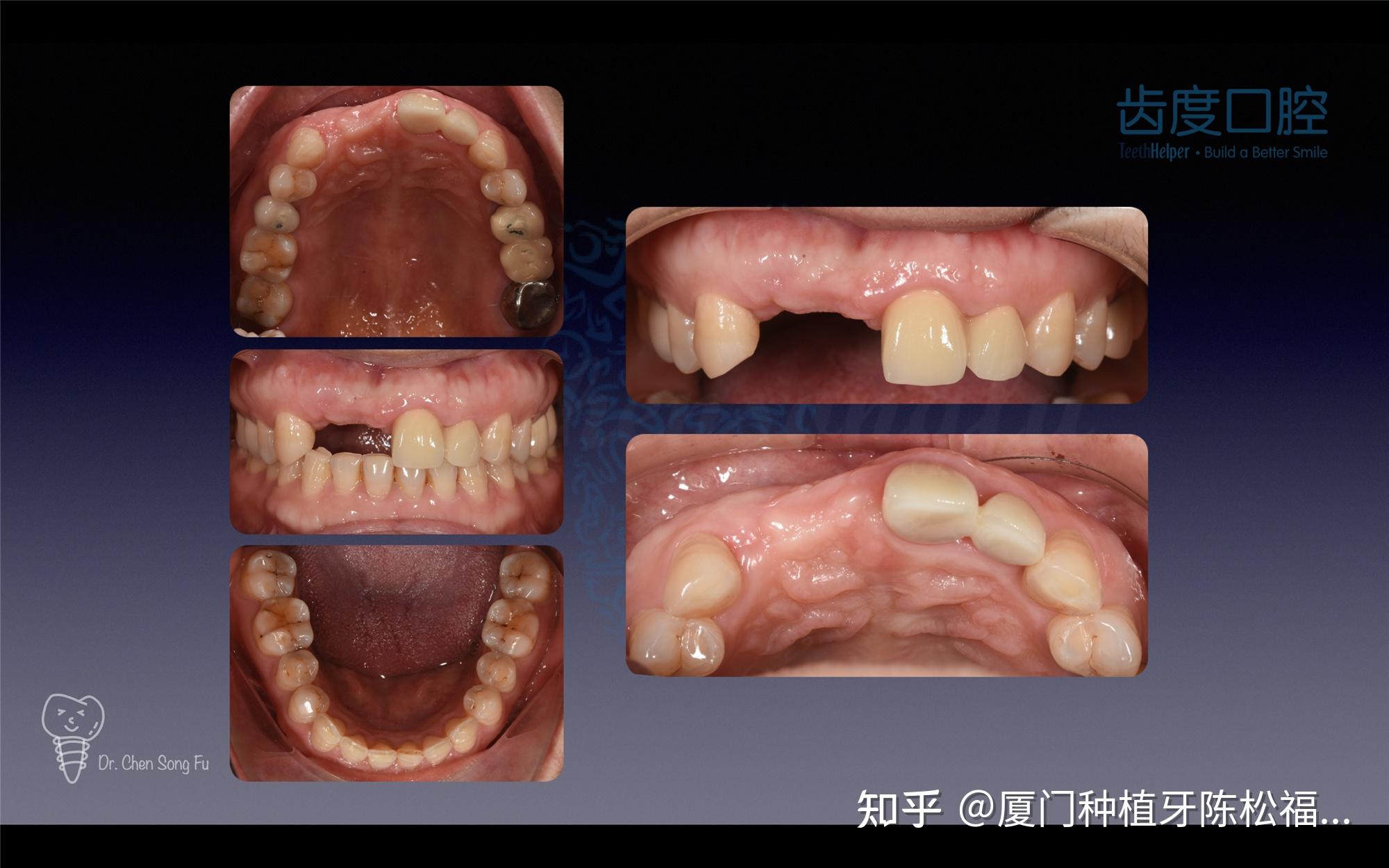 厦门种植牙案例|前牙缺失种植修复 知乎