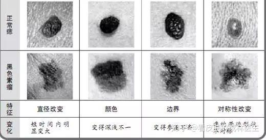 黑痣有点痛是癌变了吗？ - 知乎