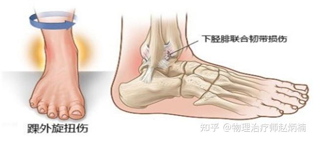 如何看待詹姆斯右脚高位踝关节扭伤会无限期休战吗